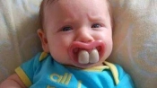 寶寶得了口角炎如何治療