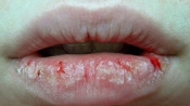 嘴唇乾裂是什麼原因呢